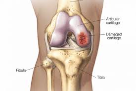 CARTILAGE RESTORATION