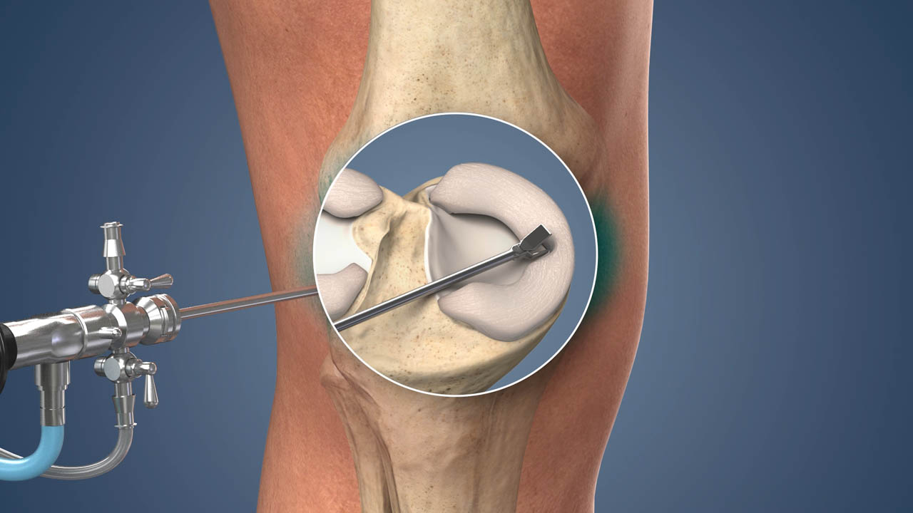 Meniscus Repair Surgery